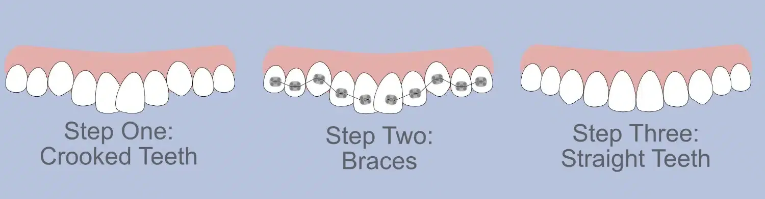 Braces in 3 easy steps