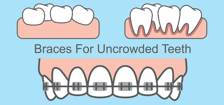 crowding teeth