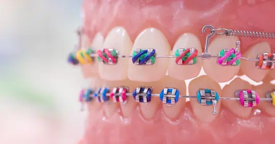 Braces Colors Ideas
