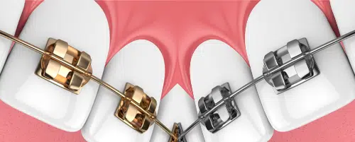 What is the difference between gold and silver-colored braces?