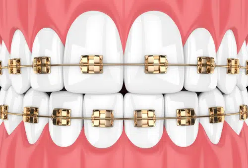 What are gold colored braces?