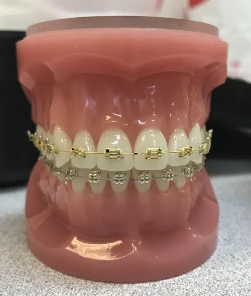 What do golden braces look like on teeth?