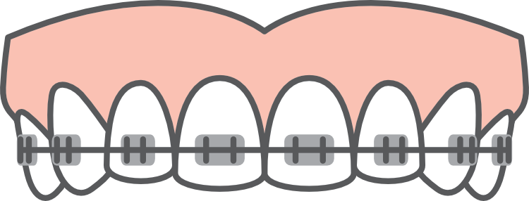 Bracket Braces