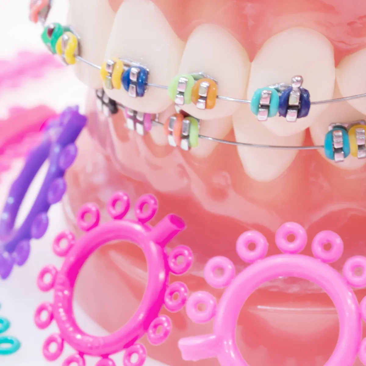 Guide to Bracket Braces