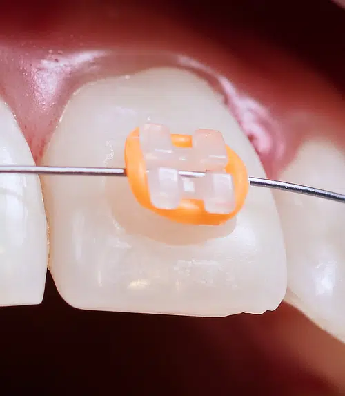 Ceramic Bracket Braces