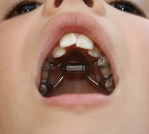 Palatal expanders at Augusta Ortho