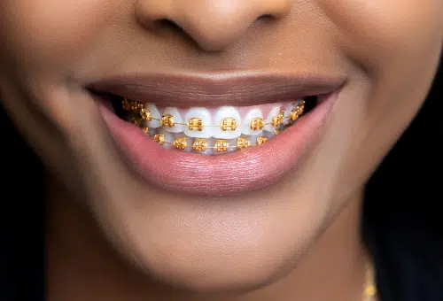 Gold braces at Augusta Orthodontics