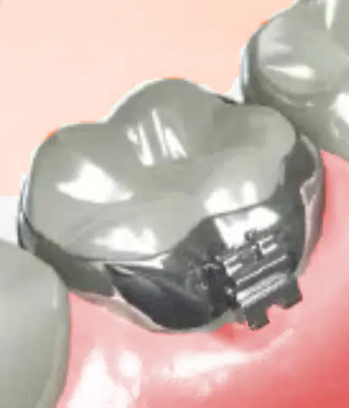 Molar Bands for Teeth