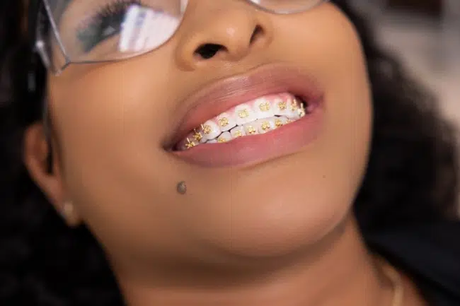 Braces removal at Augusta Orthodontics