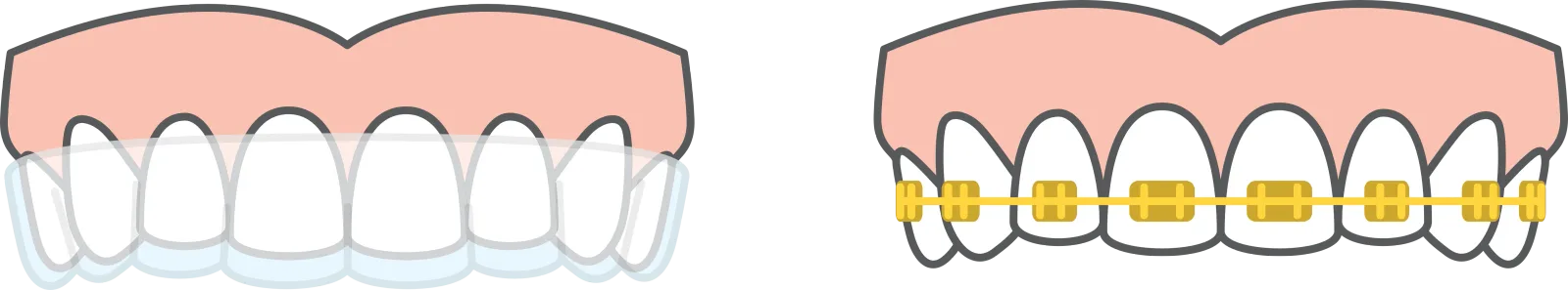 Invisalign or braces at Augusta Orthodontics