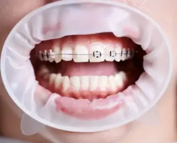 Clear ceramic braces at Augusta Orthodontics