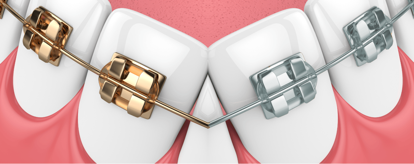 Can I change my silver braces to gold?