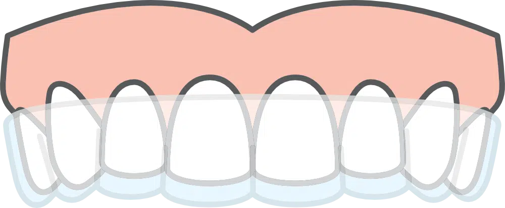 Clear Unseen braces
