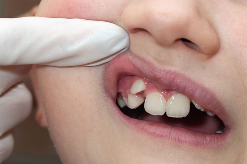 Early Signs of crooked dentition