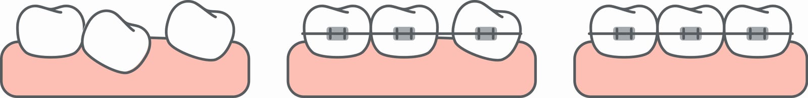Braces make uniform back teeth