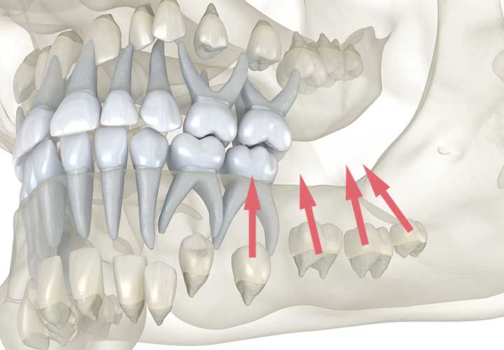 baby molars pushed out
